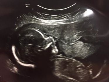 ultrasound aubrey ultrasound